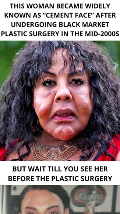 She Was Injected With Cement — See Her Shocking Transformation 14 Years Later