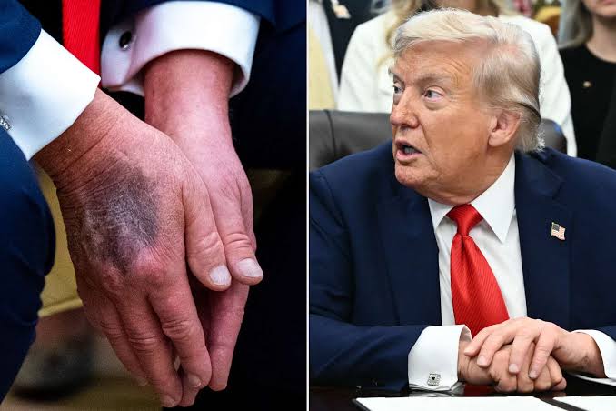 Donald Trump hospitalized after having…See more
